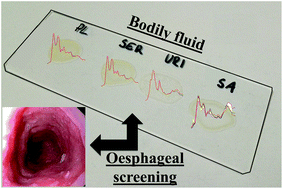 Graphical abstract: Attenuated total reflection Fourier-transform infrared spectral discrimination in human bodily fluids of oesophageal transformation to adenocarcinoma