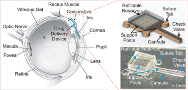 Graphical abstract: A refillable microfabricated drug delivery device for treatment of ocular diseases