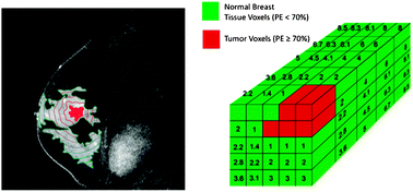 Graphical abstract: Topographic enhancement mapping of the cancer-associated breast stroma using breast MRI