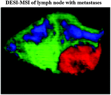 Graphical abstract: Discrimination of lymph node metastases using desorption electrospray ionisation-mass spectrometry imaging