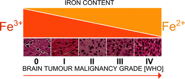 Graphical abstract: The oxidation states and chemical environments of iron and zinc as potential indicators of brain tumour malignancy grade – preliminary results