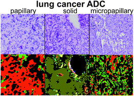 Graphical abstract: Marker-free automated histopathological annotation of lung tumour subtypes by FTIR imaging