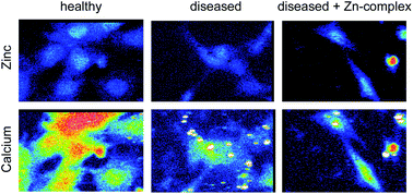 Graphical abstract: X-ray fluorescence imaging reveals subcellular biometal disturbances in a childhood neurodegenerative disorder