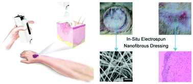 Graphical abstract: In situ deposition of a personalized nanofibrous dressing via a handy electrospinning device for skin wound care