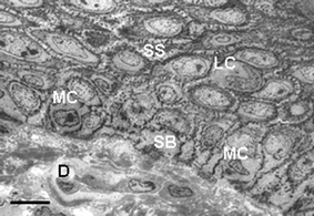 Transmission electron microscopy view of the lower epidermis of normal human skin showing keratinocytes of the S. spinosum (SS) with additional Langerhans cells (LC), and keratinocytes of the S. basale (SB) with additional melanocytes (MC). Scale bar = 20 µM.