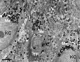 Transmission electron microscopy view of the lower epidermis of normal human skin showing the supra-basal keratinocytes (KC) containing multiple melanin granules clustered predominantly above the KC cell nucleus (Me). Note tonofilament clumps (TF). Scale bar = 2.5 µM.