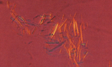 A group of negatively birefringent monosodium urate (MSU) crystals aspirated from a tophus (magnification × 1400, original magnification × 400). Reproduced with permission from ref. 91. (Copyright 1992, Ciba-Geigy Corp.)