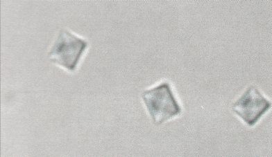 Typical calcium oxalate (CO) crystals obtained from a synovial fluid effusion in a patient on long-term dialysis (magnification × 1800, original magnification × 400). Reproduced with permission from ref. 94. (Copyright 1992, Ciba-Geigy Corp.)