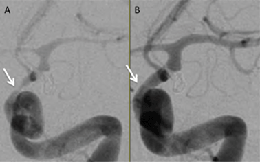 Left internal carotid artery angiogram in the arterial phase shown in a frontal projection. Both angiograms are from the same patient taken only minutes apart. Panel A shows severe spasm of the intracranial internal carotid artery (arrow) and middle cerebral artery prior to treatment. Panel B shows resolution of spasm after balloon angioplasty of the internal carotid artery and middle cerebral artery and infusion of verapamil (10 mg) into the internal carotid artery (courtesy Todd Abruzzo, MD, Mayfield Clinic).