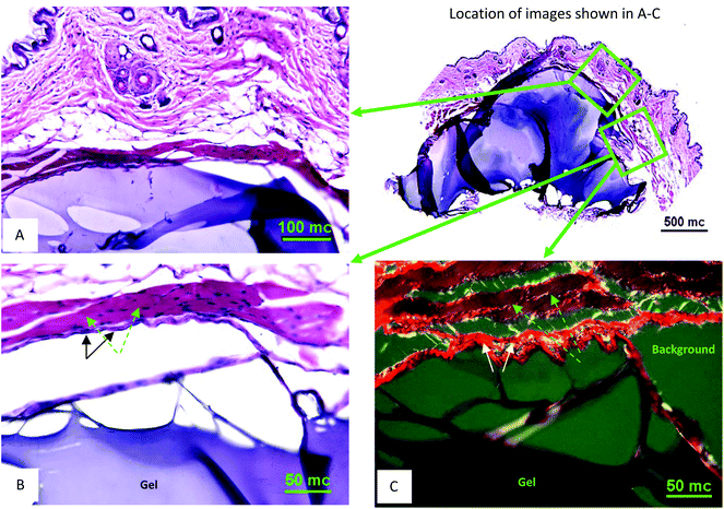 
            In vivo subcutaneous characterization of OMNCL hydrogel. (A) H&E stained tissue section at 20× magnification with gel associated with the outer skin. The gel is stained blue and surrounding tissue stained blue and red (an overview of the skin-gel injection area is shown on the right at 4× magnification). (B) H&E stained tissue section at 40× magnification from sequentially obtained tissue sections, showing the gel (blue body at the bottom), subtle fibrous capsule (marked with black arrows) and supra-capsular muscle layer (purple-red, marked with green arrows). (C) Picro-Sirius Red stained section (40× magnification) obtained from the same area as B. Hydrogel is at the bottom; the capsule surrounding the hydrogel is a bright-red fibrous structure (marked with white arrows) and muscle mass shown in brown-red (marked with green arrows). The scale bars indicate length in micrometers (mc).