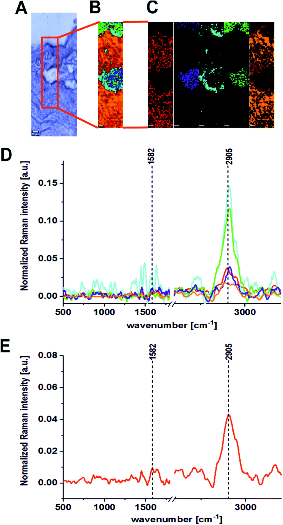 Label Free Diagnostics And Cancer Surgery Raman Spectra Guidance For