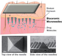 Graphical abstract: Self-setting bioceramic microscopic protrusions for transdermal drug delivery