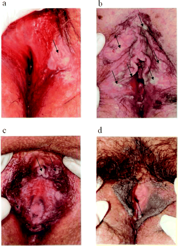 Lichen sclerosus - Wikipedia