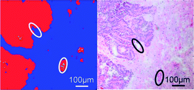 FTIR Based Classification of Carcinoma Regions in Brain Tissue 