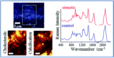 Graphical abstract: Raman microspectroscopy of human aortic valves: investigation of the local and global biochemical changes associated with calcification in aortic stenosis