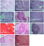 Graphical abstract: Investigating the use of Raman and immersion Raman spectroscopy for spectral histopathology of metastatic brain cancer and primary sites of origin