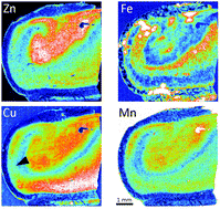 Graphical abstract: Metal maps of sclerotic hippocampi of patients with mesial temporal lobe epilepsy