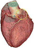 Graphical abstract: Imminent cardiac risk assessment via optical intravascular biochemical analysis