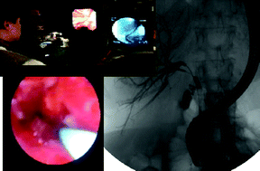 Graphical abstract: Photodynamic therapy for unresectable cholangiocarcinoma: contribution of single operator cholangioscopy for targeted treatment