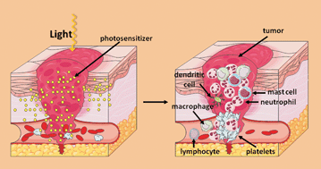 Graphical abstract: PDT-induced inflammatory and host responses