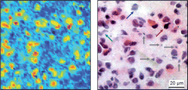 Graphical abstract: Advances in optical biopsy – correlation of malignancy and cell density of primary brain tumors using Raman microspectroscopic imaging