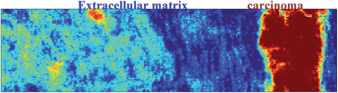 Graphical abstract: Change in the microenvironment of breast cancer studied by FTIR imaging