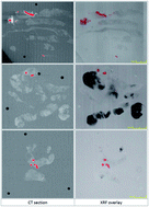 Graphical abstract: Locating microcalcifications in breast histopathology sections using micro CT and XRF mapping