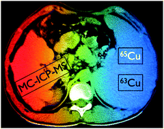 Graphical abstract: Isotopic analysis of Cu in serum samples for diagnosis of Wilson's disease: a pilot study