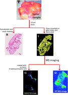 Graphical abstract: Complementarity of MALDI and LA ICP mass spectrometry for platinum anticancer imaging in human tumor