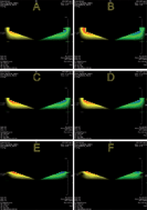 Graphical abstract: On unexpected behavior of viscosity of diethylene glycol-based MgAl2O4 nanofluids