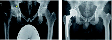 Graphical abstract: Interaction of materials and biology in total joint replacement – successes, challenges and future directions