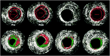 Graphical abstract: Silica–gold nanoparticles for atheroprotective management of plaques: results of the NANOM-FIM trial