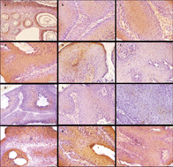 Graphical abstract: A low toxic synthetic dendrimer conjugated podophyllotoxin nanodevice with potent antitumor activity against the DMBA/TPA induced mouse skin carcinogenesis model