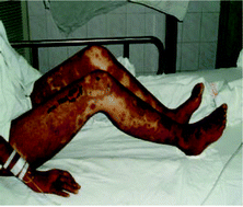 Graphical abstract: Trichloroethylene-induced hypersensitivity dermatitis was associated with hepatic metabolic enzyme genes and immune-related genes