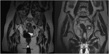 Graphical abstract: Treatment of cervix carcinoma FIGO IIIb with Photofrin II as a radiosensitizer: a case report