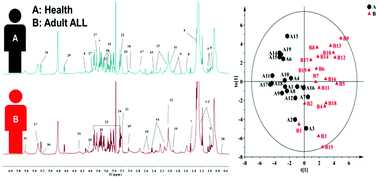 Graphical abstract: NMR-based plasma metabolomics of adult B-cell acute lymphoblastic leukemia