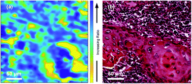 Graphical abstract: Insight into metastatic oral cancer tissue from novel analyses using FTIR spectroscopy and aperture IR-SNOM