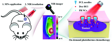 Graphical abstract: Build an implanted “arsenal”: detachable microneedles for NIR-triggered cancer photothermo-chemotherapy