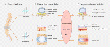 Graphical abstract: Silk fibroin-based biomaterials for disc tissue engineering