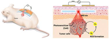 Graphical abstract: An implantable ionic therapeutic platform for photodynamic therapy with wireless capacitive power transfer