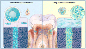 Graphical abstract: Biomineralization-inspired sandwich dentin desensitization strategy based on multifunctional nanocomposite with yolk–shell structure