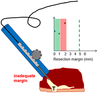 Graphical abstract: Intraoperative assessment of resection margins by Raman spectroscopy to guide oral cancer surgery