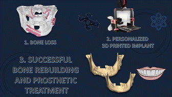 Graphical abstract: Design, clinical applications and post-surgical assessment of bioresorbable 3D-printed craniofacial composite implants
