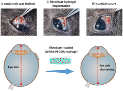 Graphical abstract: 3D printed fibroblast-loaded hydrogel for scleral remodeling to prevent the progression of myopia
