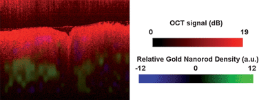Graphical abstract: Imaging gold nanorods in excised human breast carcinoma by spectroscopic optical coherence tomography