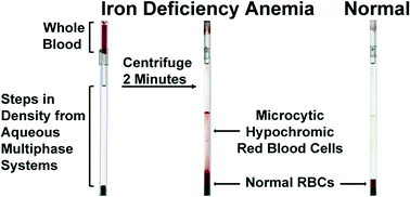 Graphical abstract: Diagnosis of iron deficiency anemia using density-based fractionation of red blood cells