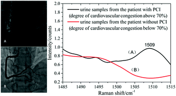 Graphical abstract: Noninvasive and prospective diagnosis of coronary heart disease with urine using surface-enhanced Raman spectroscopy