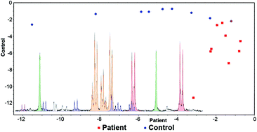 Graphical abstract: Diagnosis of pancreatic cancer via1H NMR metabolomics of human plasma
