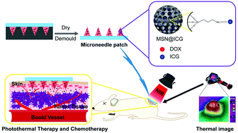 Graphical abstract: Composite-dissolving microneedle patches for chemotherapy and photothermal therapy in superficial tumor treatment