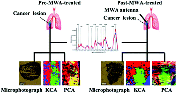 Graphical abstract: Study on the biochemical mechanisms of the micro-wave ablation treatment of lung cancer by ex vivo confocal Raman microspectral imaging